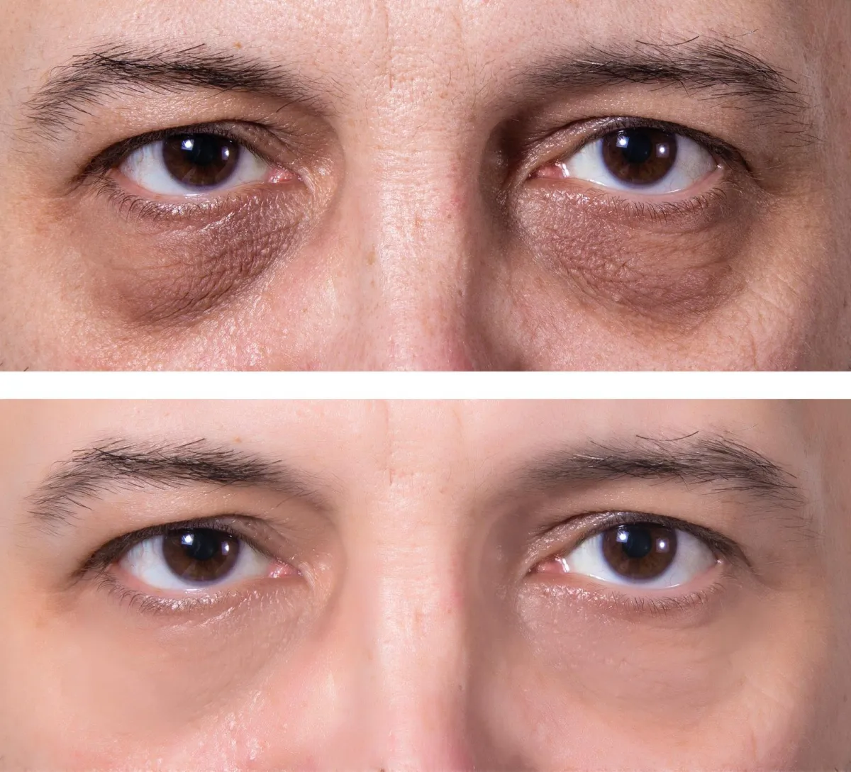Under-Eye Dark Circles & Bags before and after result 2