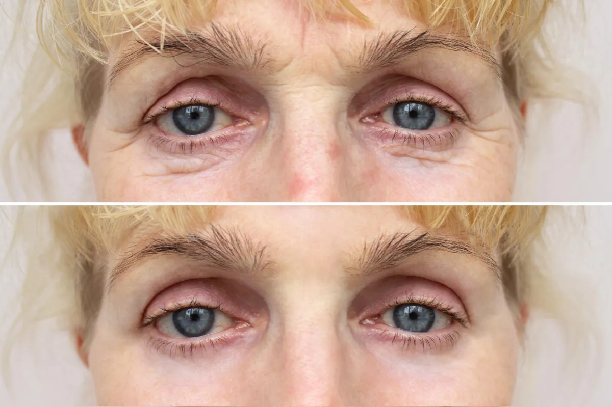 Under-Eye Dark Circles & Bags before and after result 1