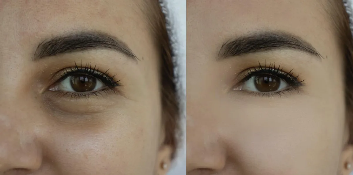 Under-Eye Dark Circles & Bags before and after result 3