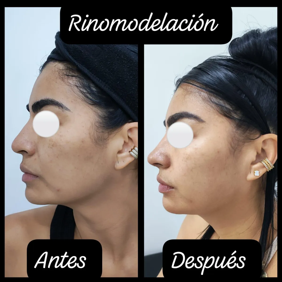 Resultado de paciente - Abdominoplastia