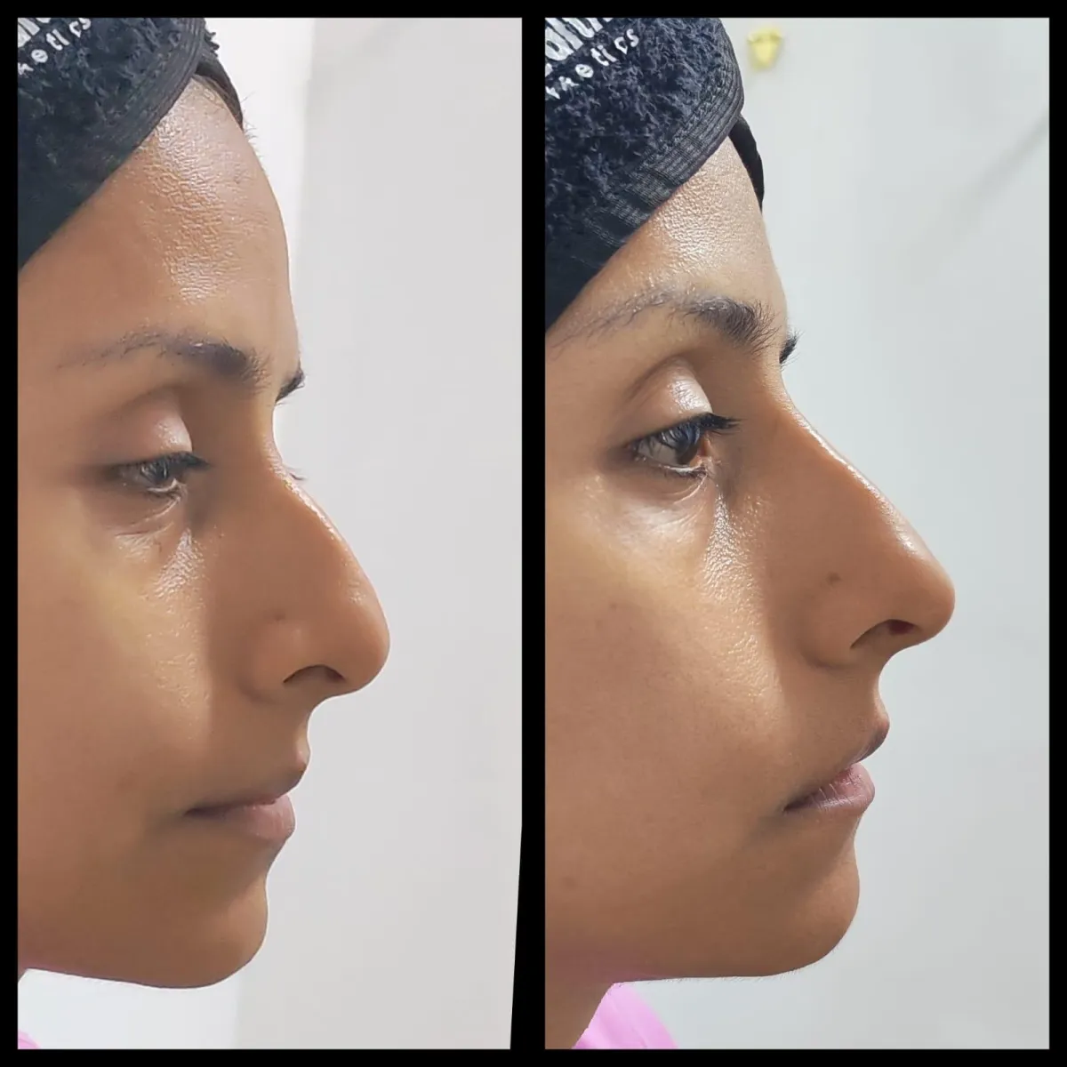 Resultado de paciente - Mamoplastia