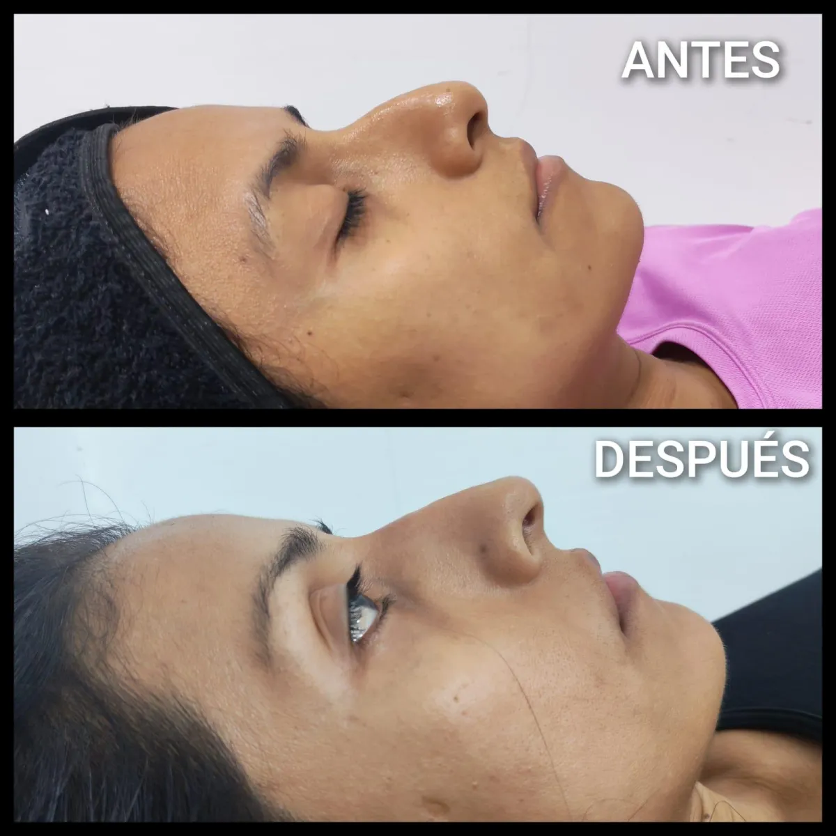 Resultado de paciente - Lifting Facial