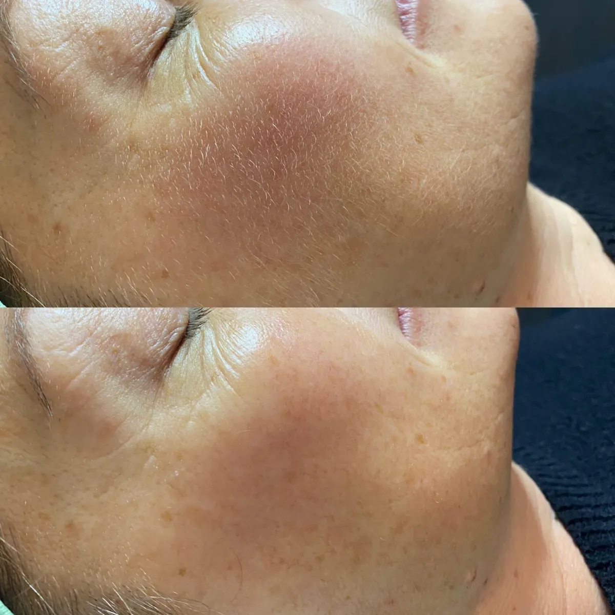 dermaplaning before after case 2