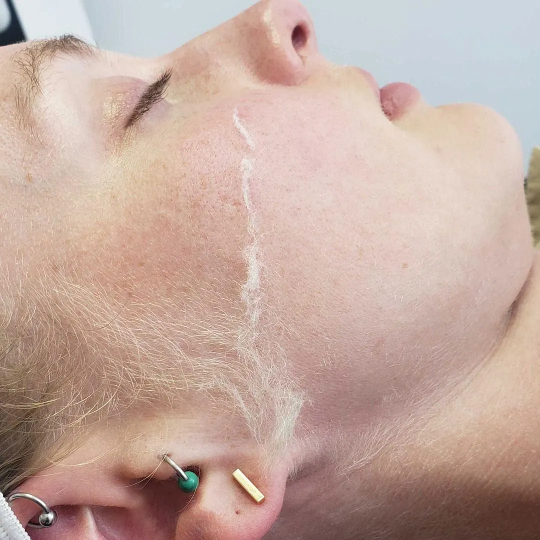 dermaplaning before after case 1