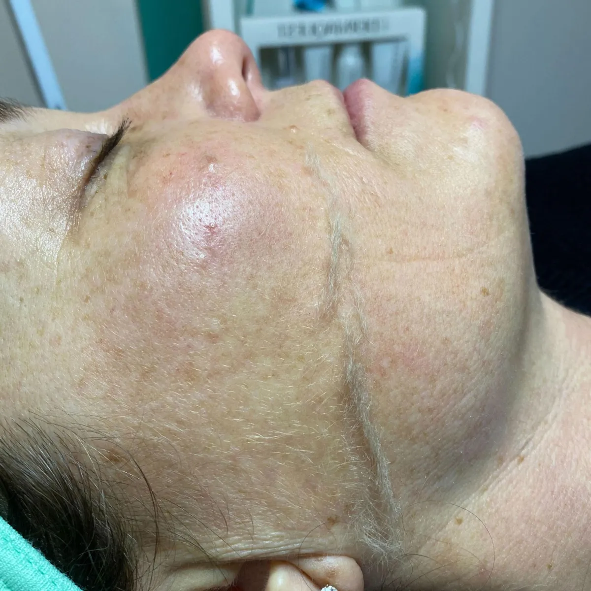 dermaplaning before after case 3