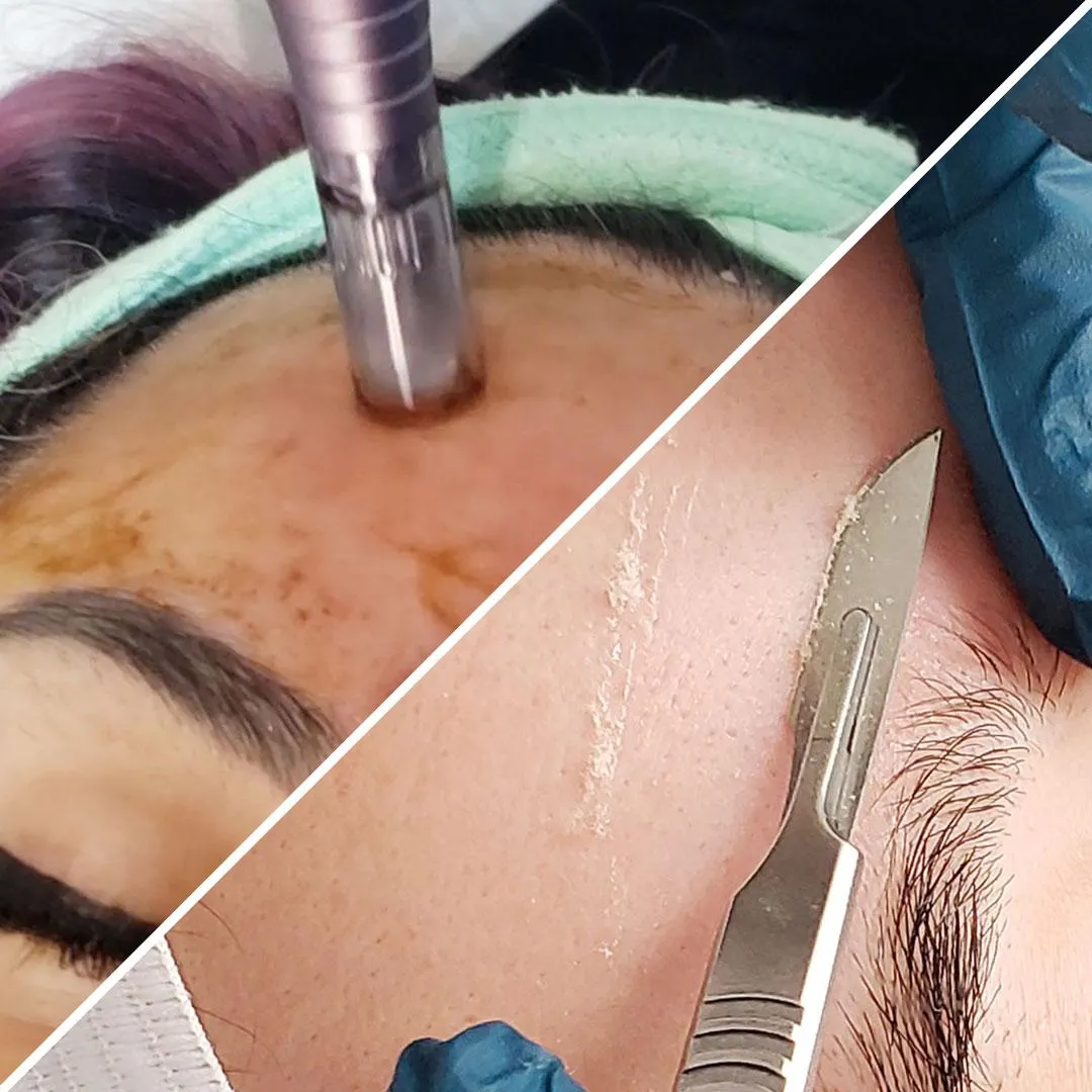 free dermaplaning with nano infusion