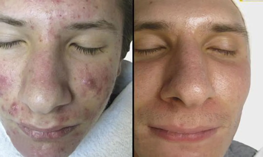 60 day clear skin challenge testimonial robby