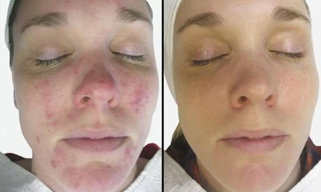 60 day clear skin challenge testimonial charity