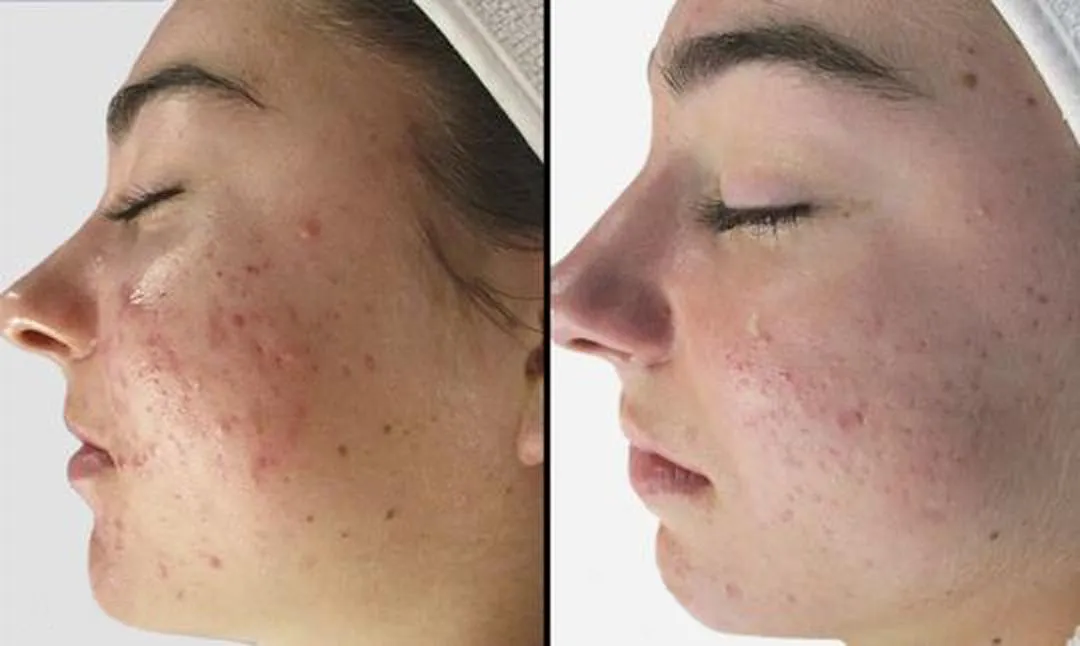 60 day clear skin challenge testimonial audey