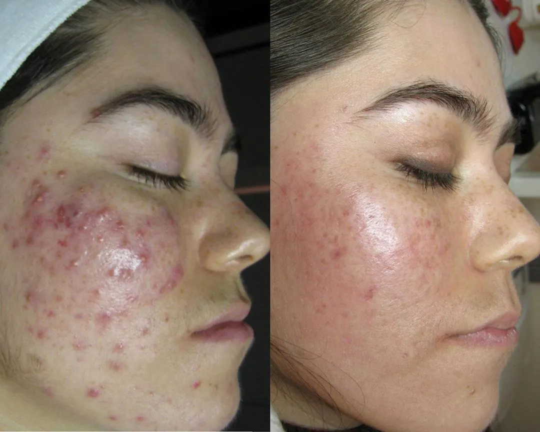 60 day clear skin challenge case study anna