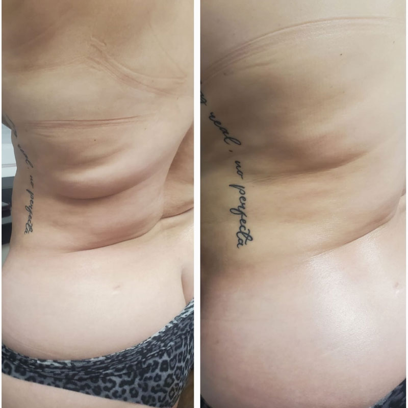 Body contouring treatment at Tampa beauty salon