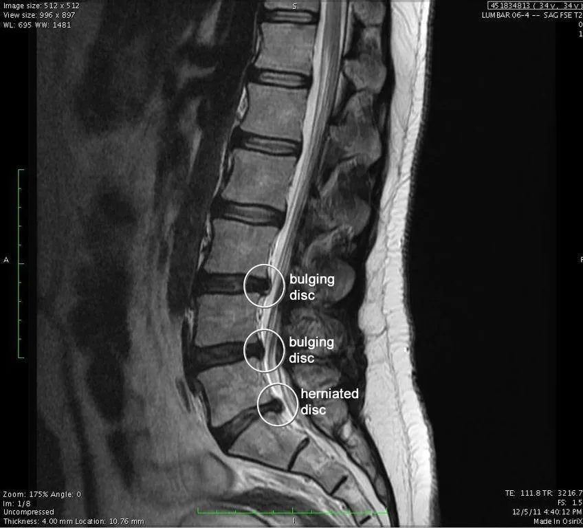 Spine X-ray illustrating spinal injury diagnosis at Physio Barnsley.