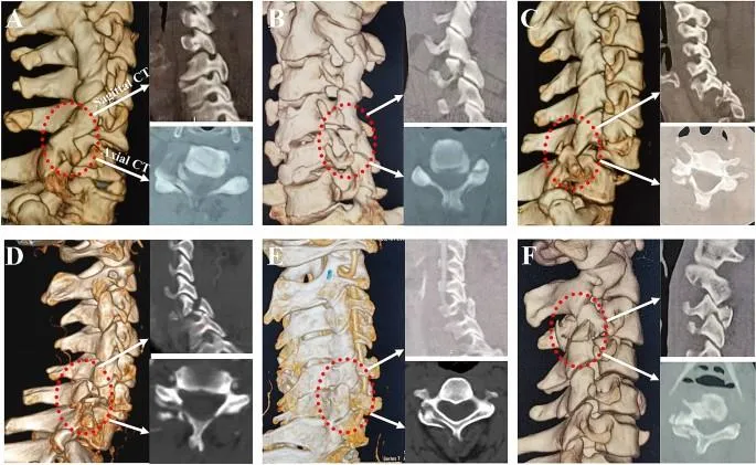 Vertebrae illustration showing stuck and stiff joints for physiotherapy at Physio Barnsley.