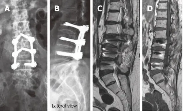 Spine X-ray with surgical screws, illustrating post-surgery rehabilitation at Physio Barnsley.
