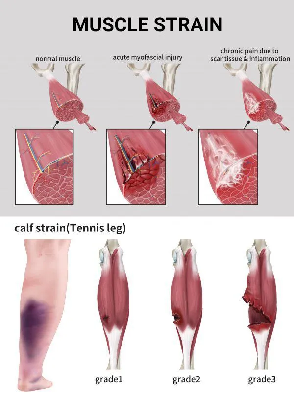 Illustration of calf muscle strain grading, showing different degrees of tear for physiotherapy at Physio Barnsley.