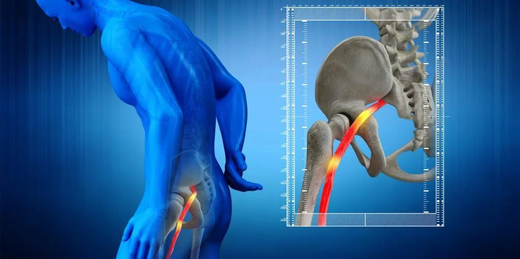 Illustration of a pinched nerve in the pelvis, representing physiotherapy treatment at Physio Barnsley.