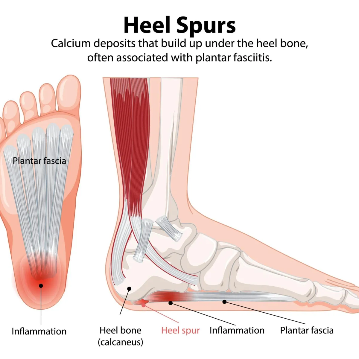 Illustration of heel spurs and plantar fasciitis, representing shockwave therapy treatment at Physio Barnsley.