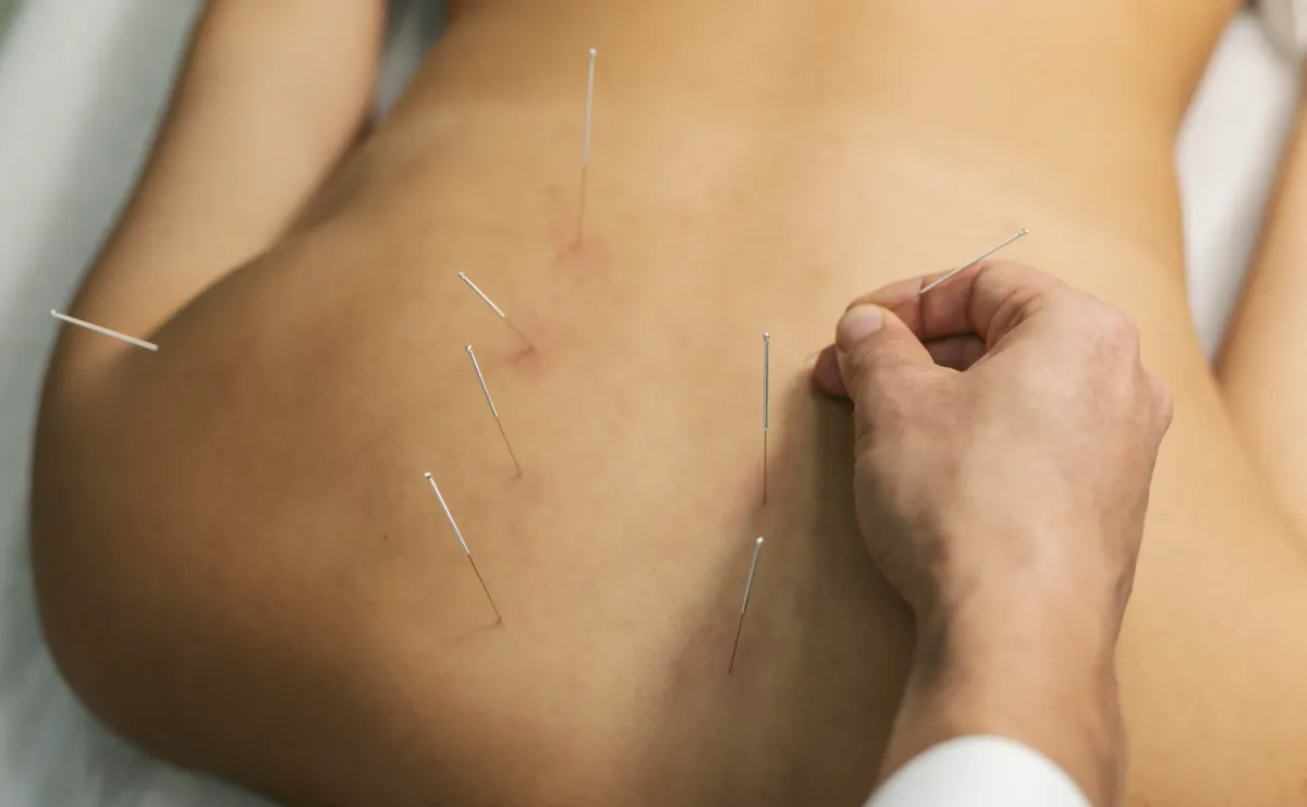 Acupuncture for Spinal Stenosis Pain in NYC
