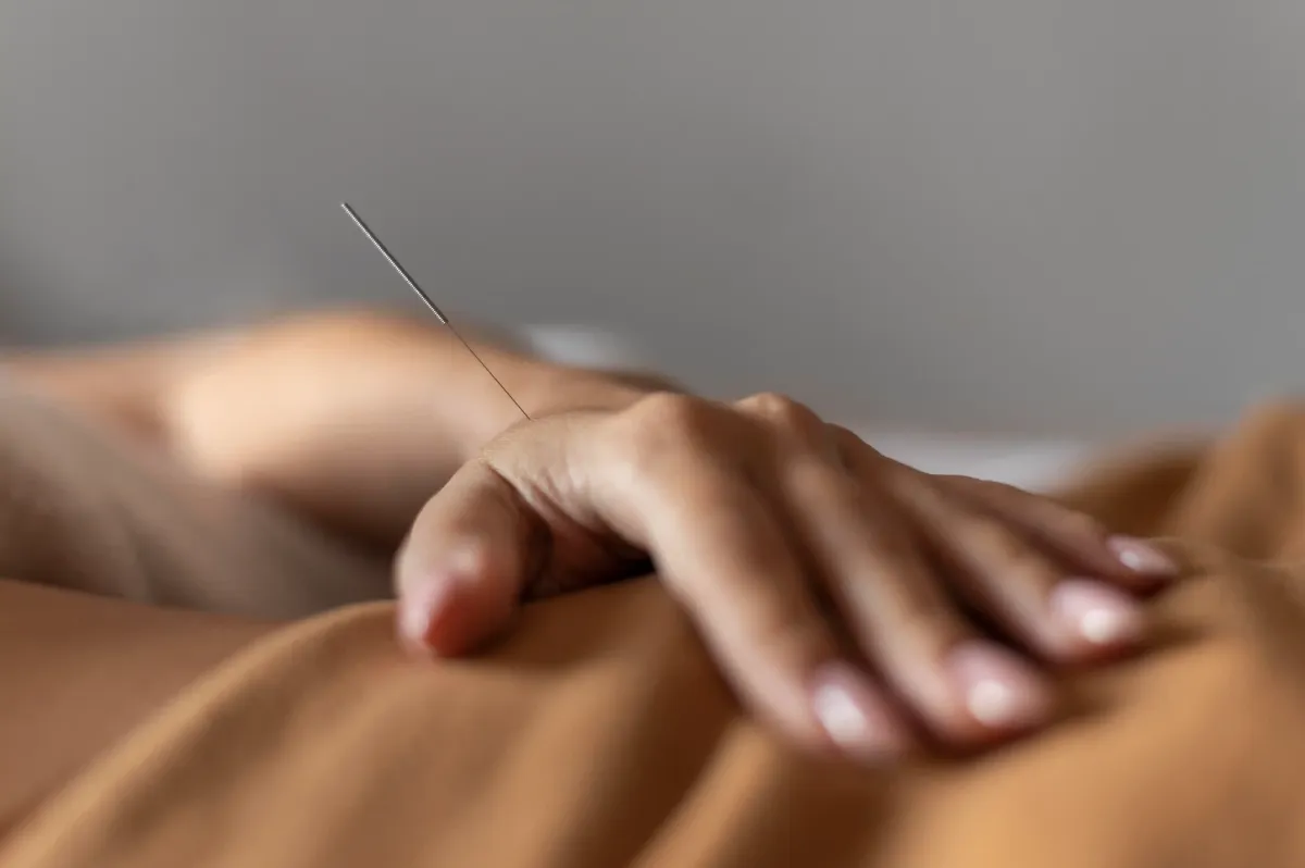 Acupuncture for Carpal Tunnel Syndrome in NYC