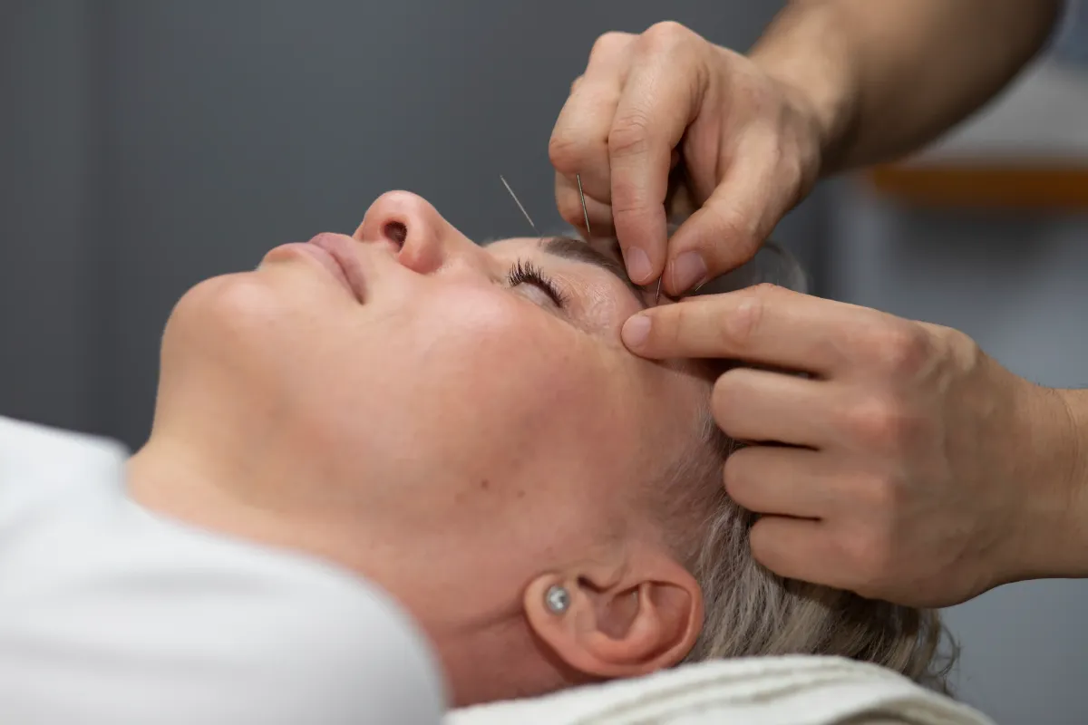 Dry Needling For Tension Headaches In NYC