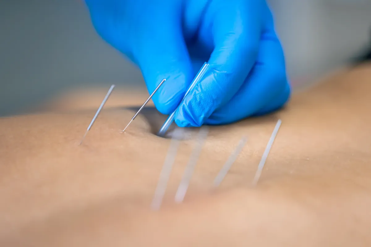 Dry Needling for Hip Pain in NYC