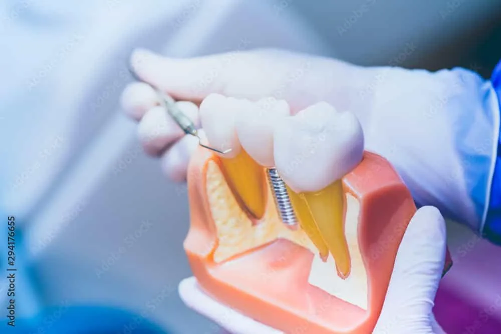 Dental Implants Services