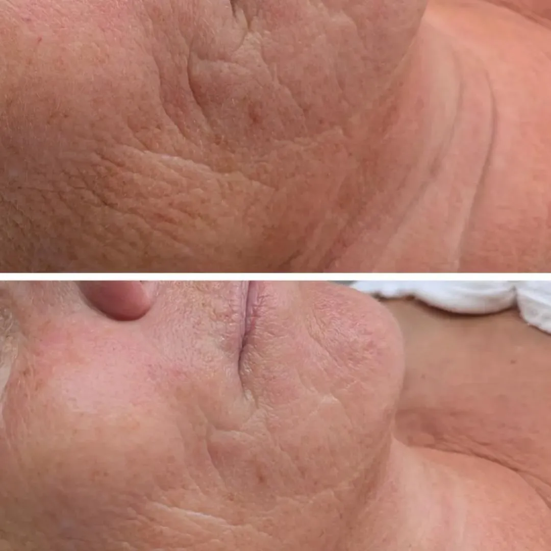 Anti-Aging Behandlung Schönberg
