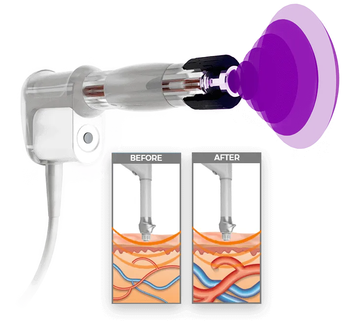 Phoenix Acoustic Wave Therapy Device