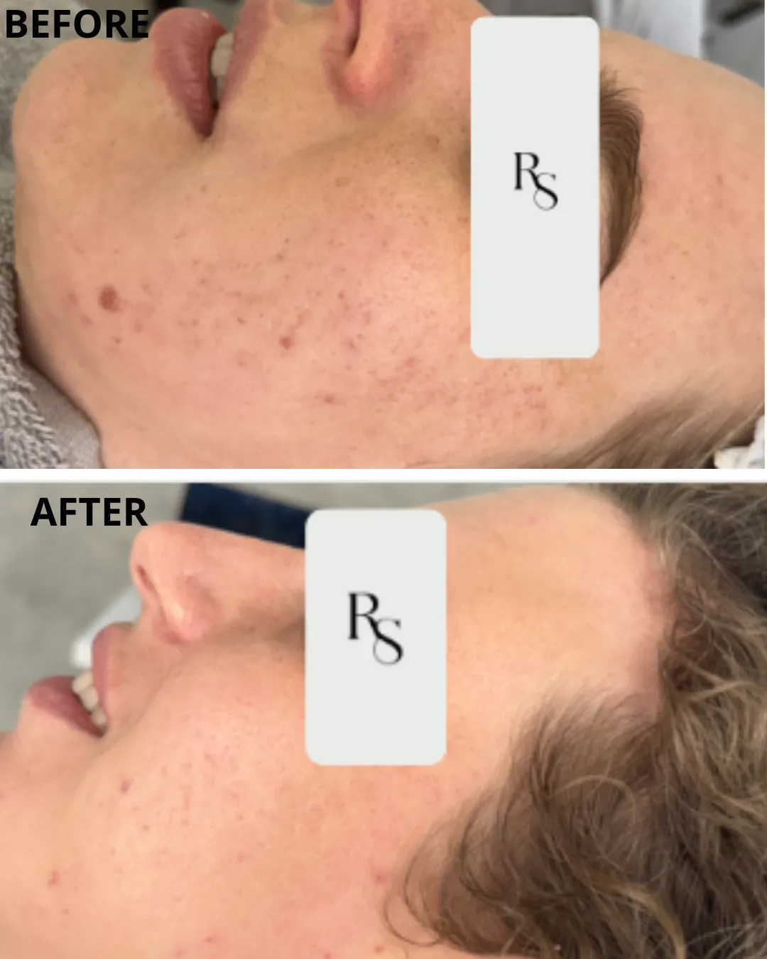 Best Acne Treatment in South Africa: Doctor-Approved Solutions for Clear, Confident Skin