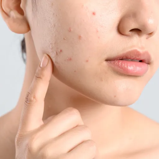 Hormonal Acne in Adults: Why It Happens and How to Treat It