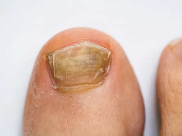 Ingrown and Fungal Nailsat South Hill Foot & Ankle Clinic