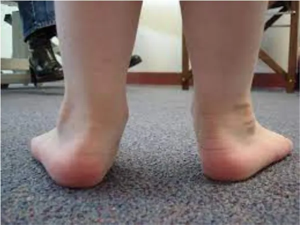Flat Feet Treatment with HyProCure