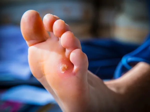 Corns and Calluses at South Hill Foot & Ankle Clinic