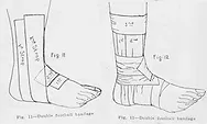 A drawn diagram demonstrating how sports tape should be wrapped around the foot and ankle 