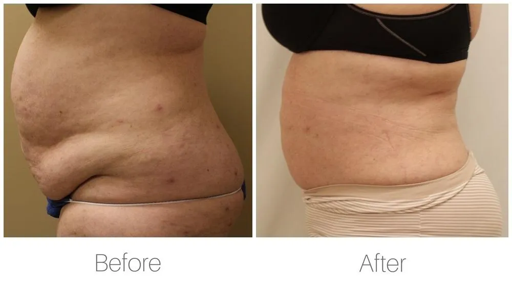 Laser Liposuction before and after