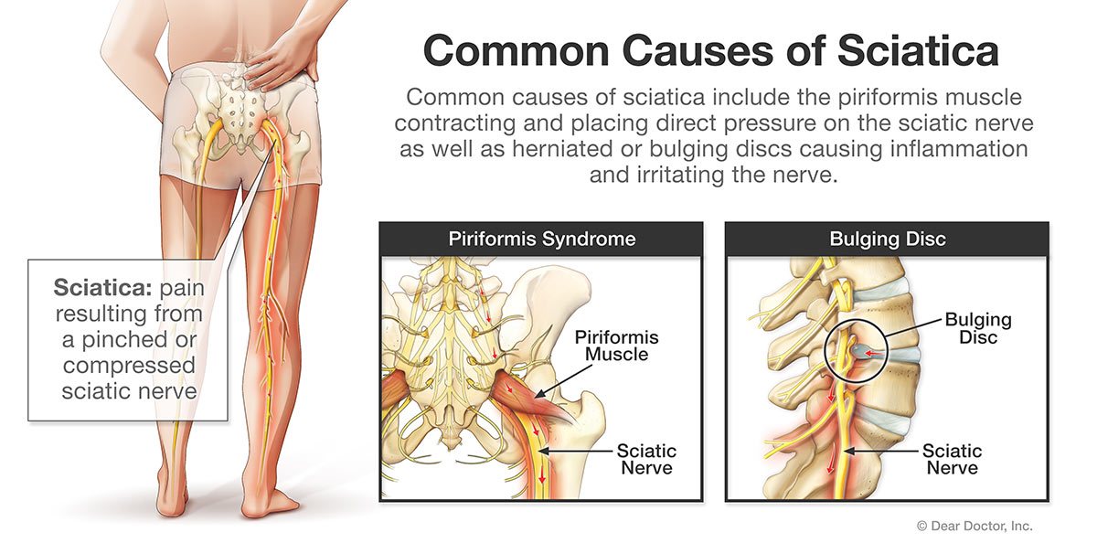 Can Spinal Decompression Help Sciatica Pain?
