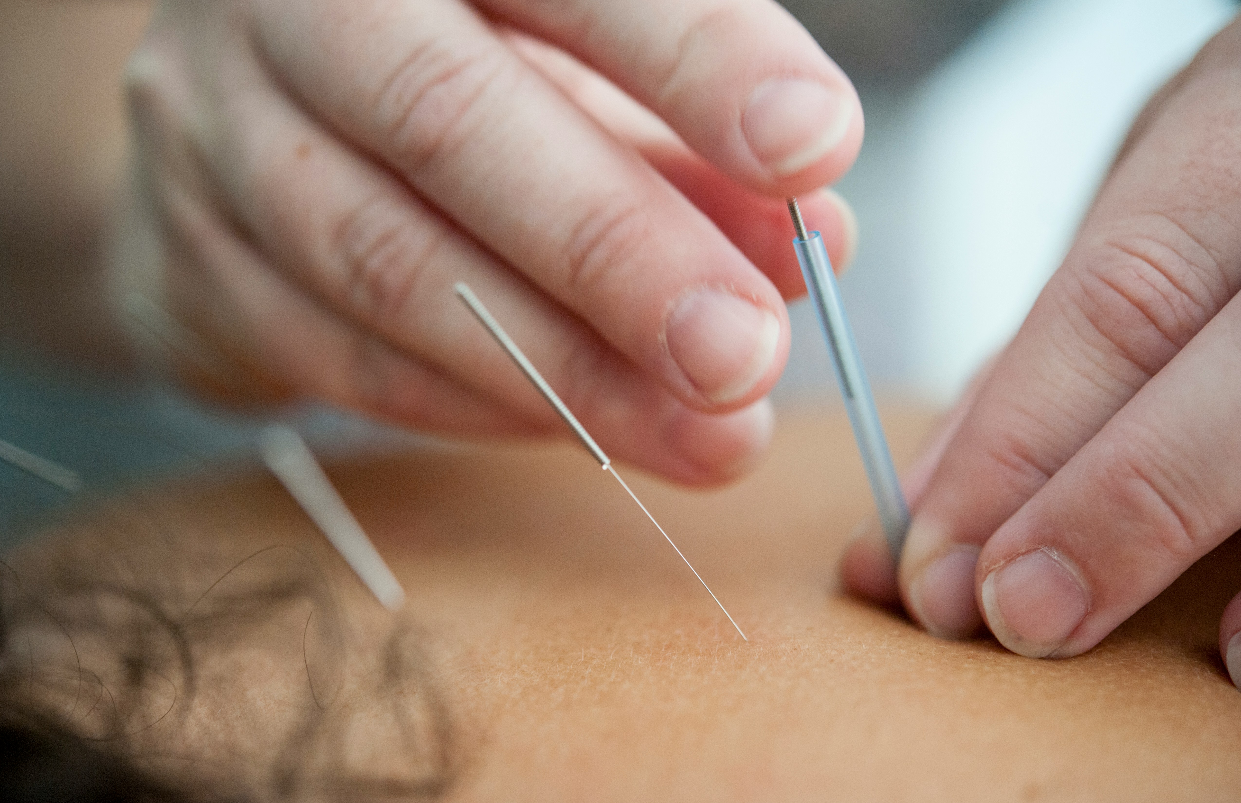 Dry Needling in California: Why PTs Don’t Offer It & What Works Instead