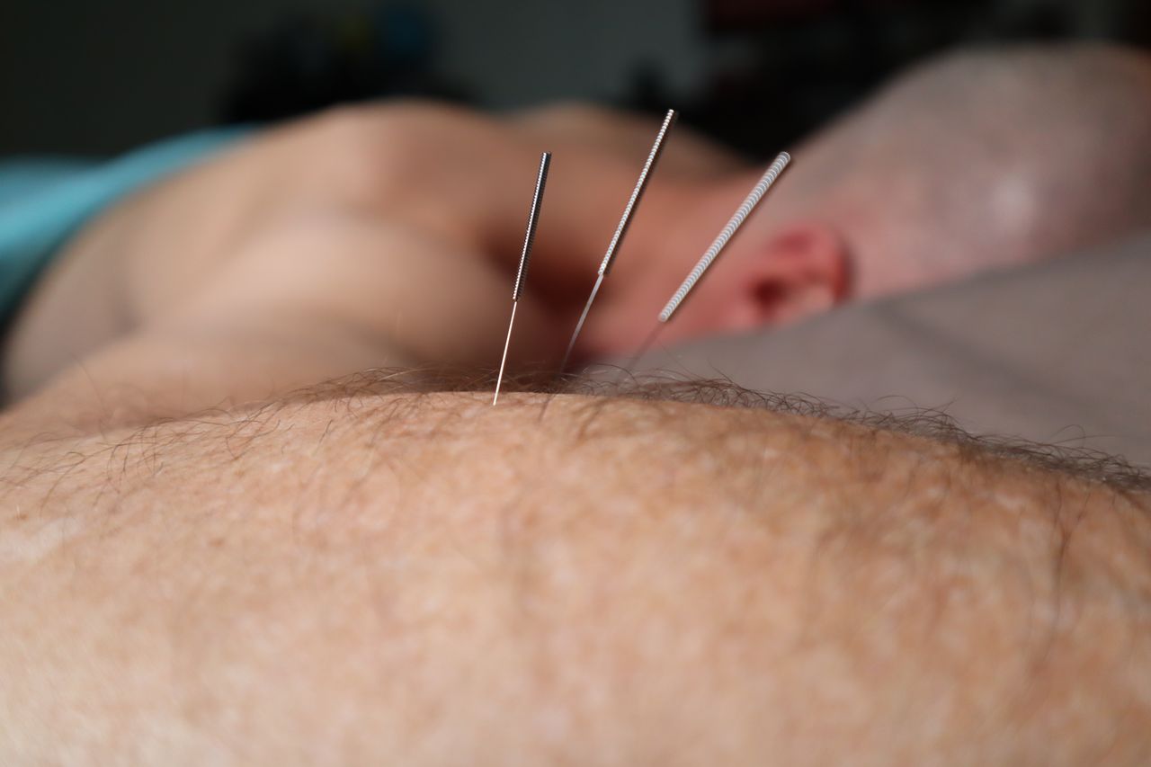 IMS Dry needling at Surge Wellness Surrey bc