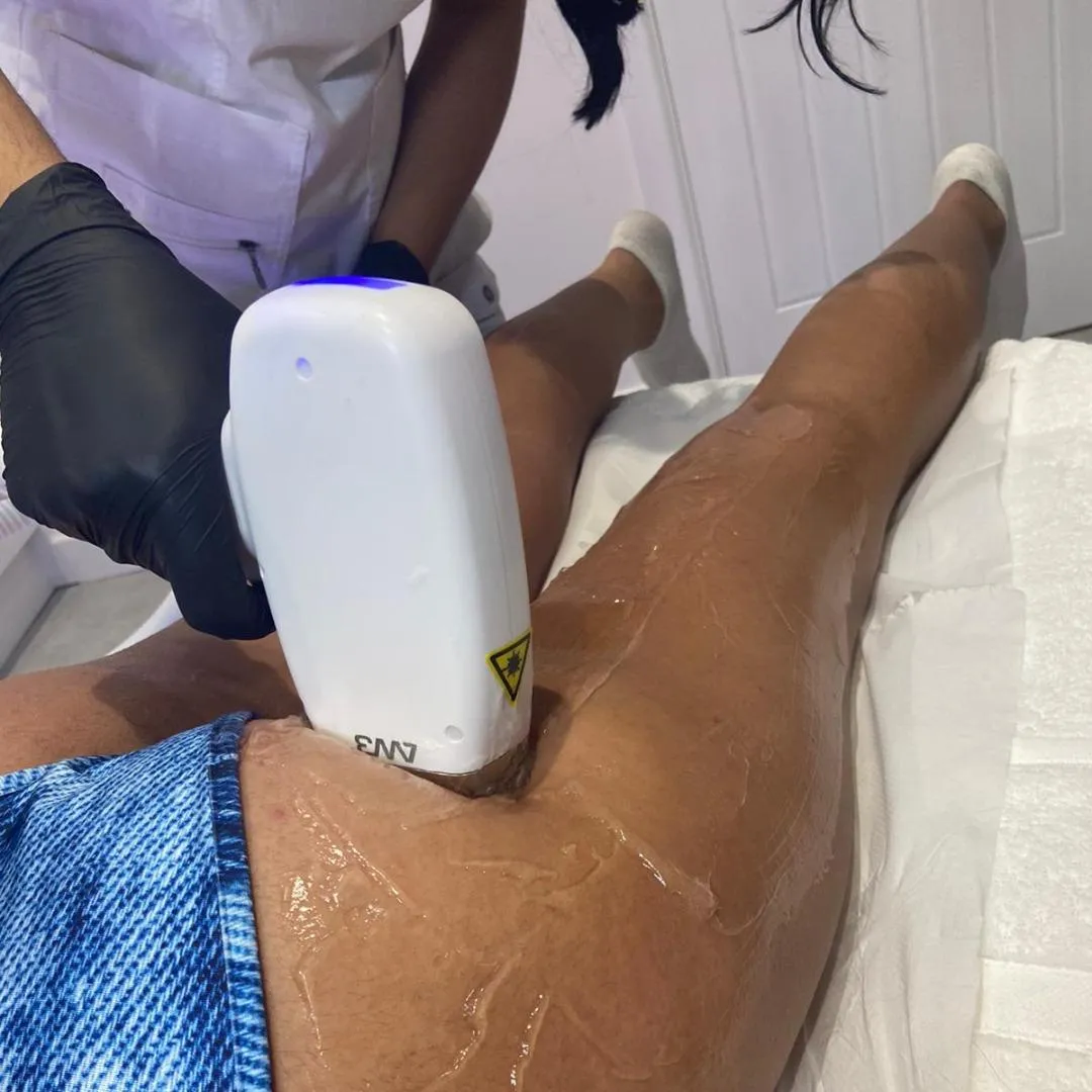 Laser location laser hair removal lower body