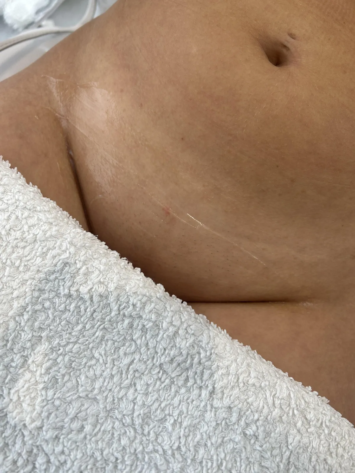 laser location hollywood laer hair removal treatment in manchester