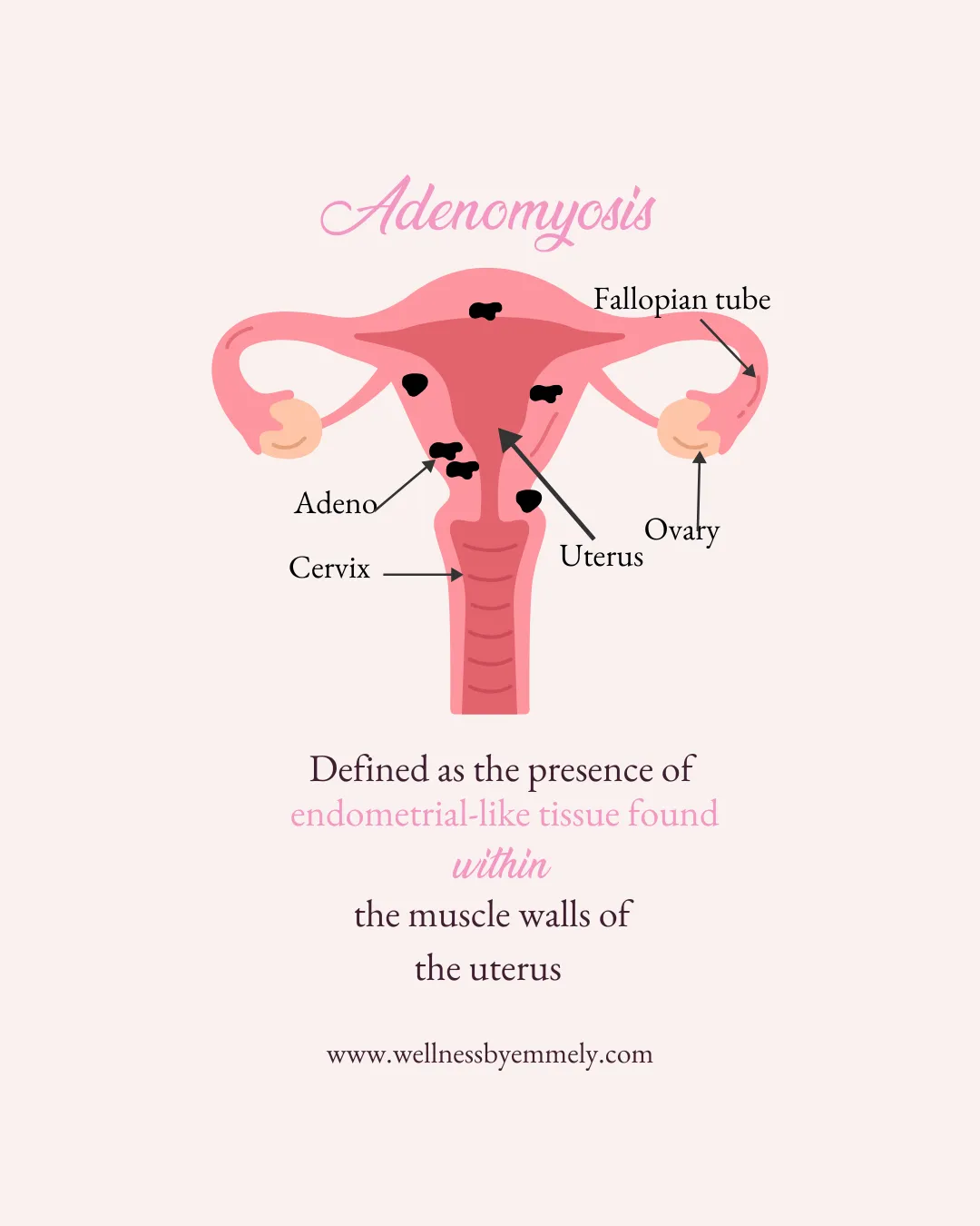 diagram showing adenomyosis in uterus muscle wall
