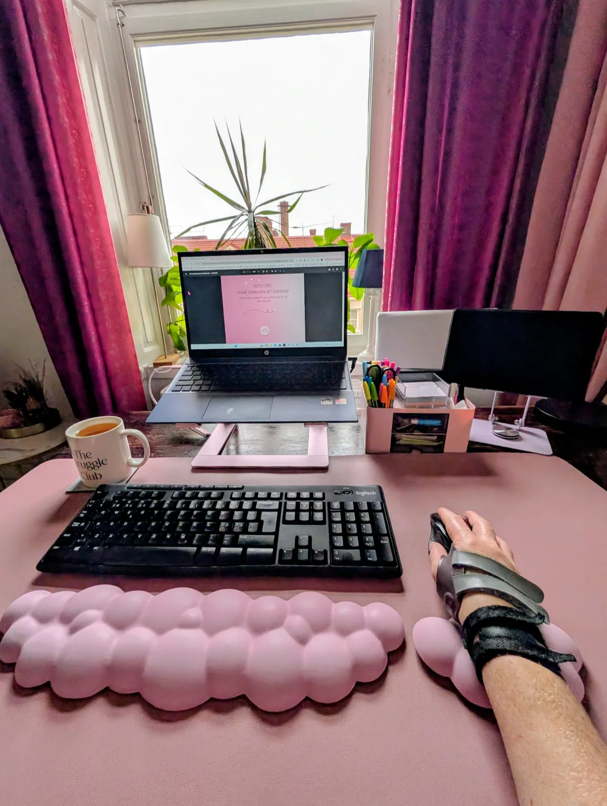 Emmely using a mouse while wearing a wrist and thumb brace at a desk with cushioned wrist rests, an external keyboard, and a laptop on a raised stand.