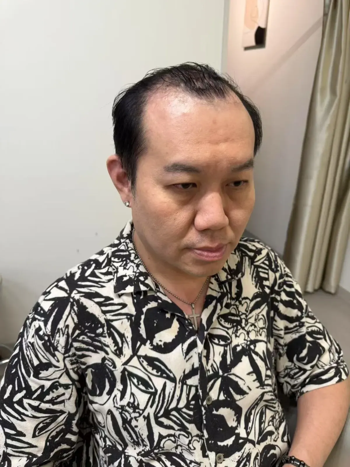 Before hair wig application for hair thinning