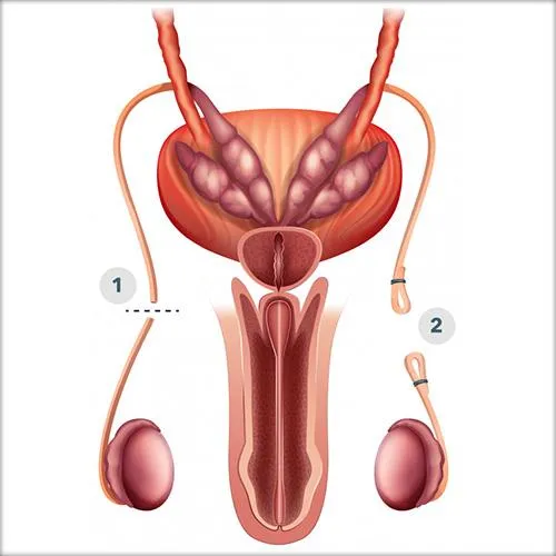 Vasectomy image 