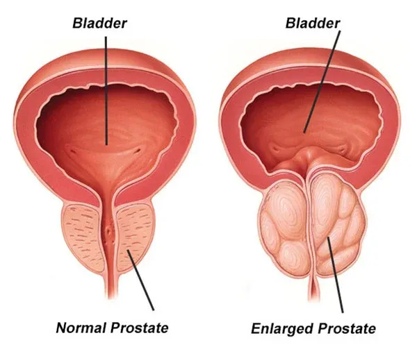 Enlarged prostate image 