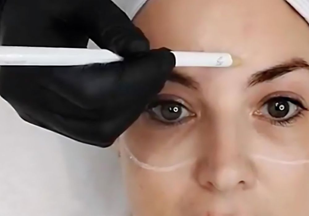 EndyBleph eye-area treatment in progress