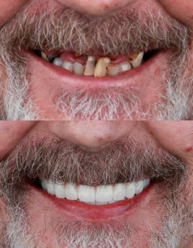 Fixed Dentures