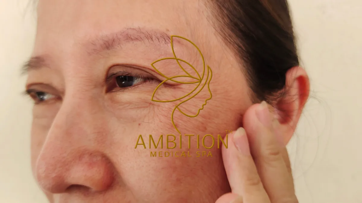 Ambition Medical Spa | What are Wrinkles?