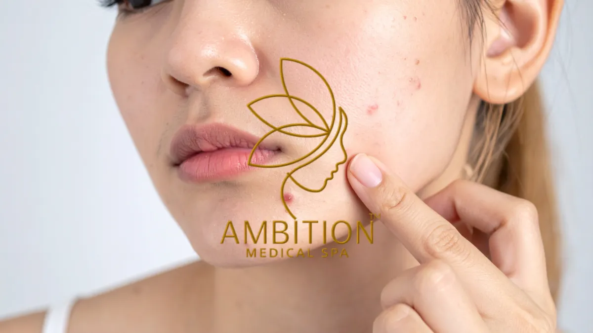 Ambition Medical Spa | What is Acne?