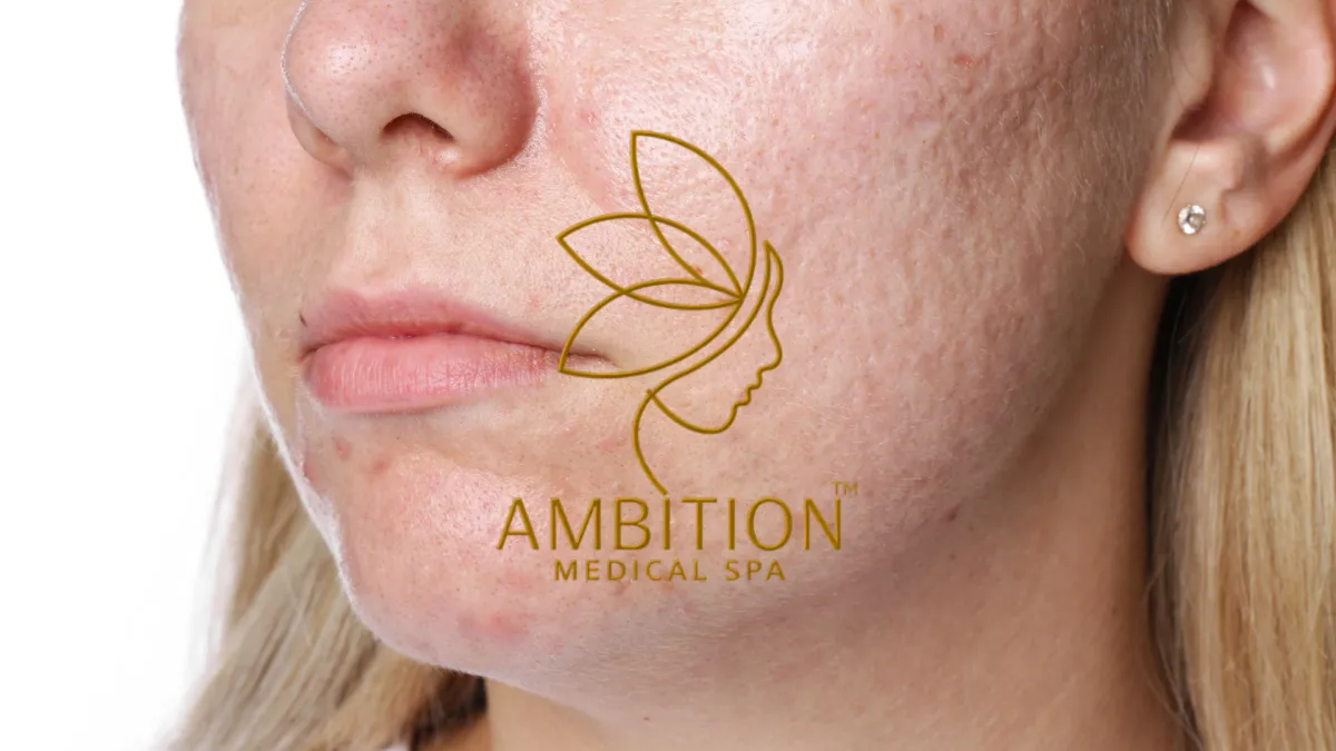 Ambition Medical Spa | What are Large Pores?